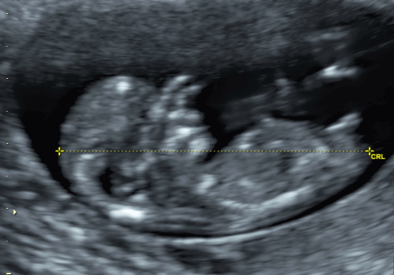 Termijnecho, due date scan, ultrasound, eerste trimester